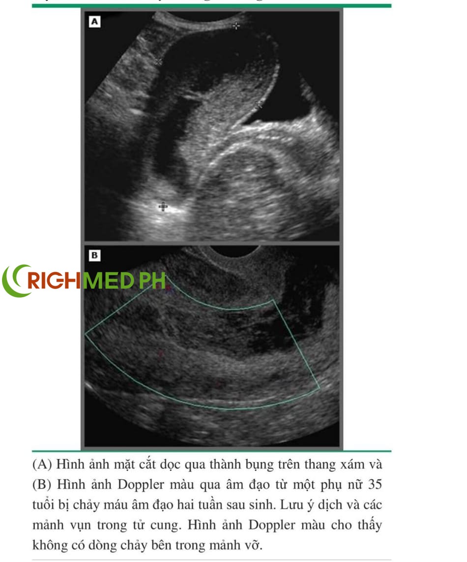 Dịch và các mảnh vụn trong tử cung sau sinh